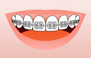 Smiling mouth displaying metal braces on upper teeth against pink background.