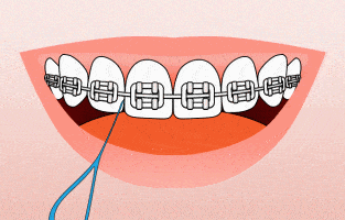 Smiling mouth displaying metal braces with blue floss threader for orthodontic care.
