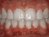 Close-up of white dental veneers or crowns on upper front teeth showing professional cosmetic dentistry results.