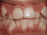 Close-up view of upper and lower teeth showing orthodontic treatment progress and dental alignment.