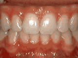 Close-up of upper front teeth showing orthodontic treatment progress with visible brackets and wires on dental model.