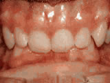 Close-up view of upper front teeth showing dental alignment and gum health in clinical setting.