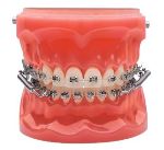 Dental model with metal braces showing orthodontic treatment for teeth alignment and correction.