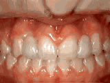 Close-up view of patient's teeth showing orthodontic treatment progress with visible braces and alignment corrections.