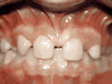 Close-up intraoral view of child's upper teeth showing mixed dentition with spacing and malocclusion.