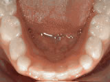 Intraoral view of lower teeth and gums showing orthodontic treatment progress