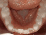 Close-up intraoral view showing lower teeth and gums during orthodontic examination or treatment documentation.