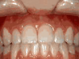 Close-up of aligned upper and lower teeth showing successful orthodontic treatment results.