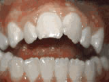 Close-up of upper and lower teeth showing orthodontic treatment results with proper alignment and bite.
