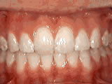 Close-up of upper and lower teeth showing orthodontic alignment and whitening results.