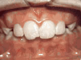 Close-up of healthy front teeth and gums showing a bright smile with proper dental alignment.