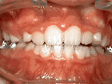 Close-up of teeth showing orthodontic treatment progress with braces and brackets on upper teeth.