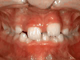 Child's upper teeth showing gaps and misalignment requiring orthodontic treatment.