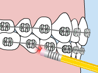 Orthodontic braces on teeth with yellow toothbrush cleaning between brackets and wires.