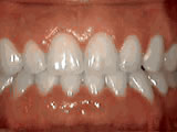 Close-up of upper and lower teeth showing dental alignment and bite relationship during orthodontic treatment.