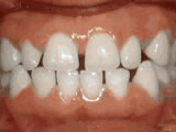 Close-up of upper front teeth showing orthodontic treatment with brackets and wires on dental model.