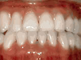 Close-up of patient's upper teeth showing orthodontic treatment results with proper alignment and spacing.