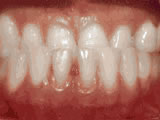 Close-up of upper front teeth showing white spots and discoloration on tooth enamel surface.