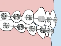 Orthodontic braces on teeth showing metal brackets and wires for dental alignment treatment.
