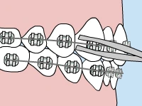Orthodontic braces on teeth showing metal brackets, wires, and bands against pink and blue background.