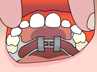 Patient's open mouth displaying dental braces and orthodontic appliance during examination.