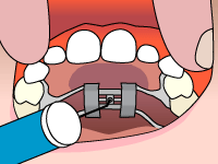 Dentist applies metal braces to upper teeth during orthodontic treatment procedure.