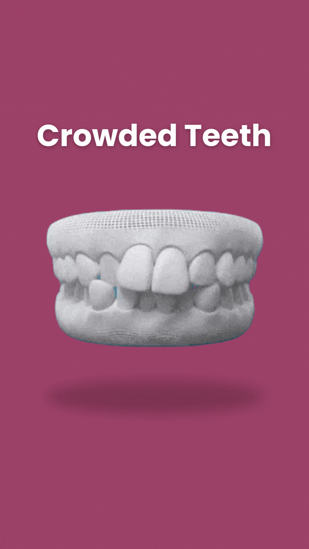 Dental model displaying crowded teeth on pink background for orthodontics education