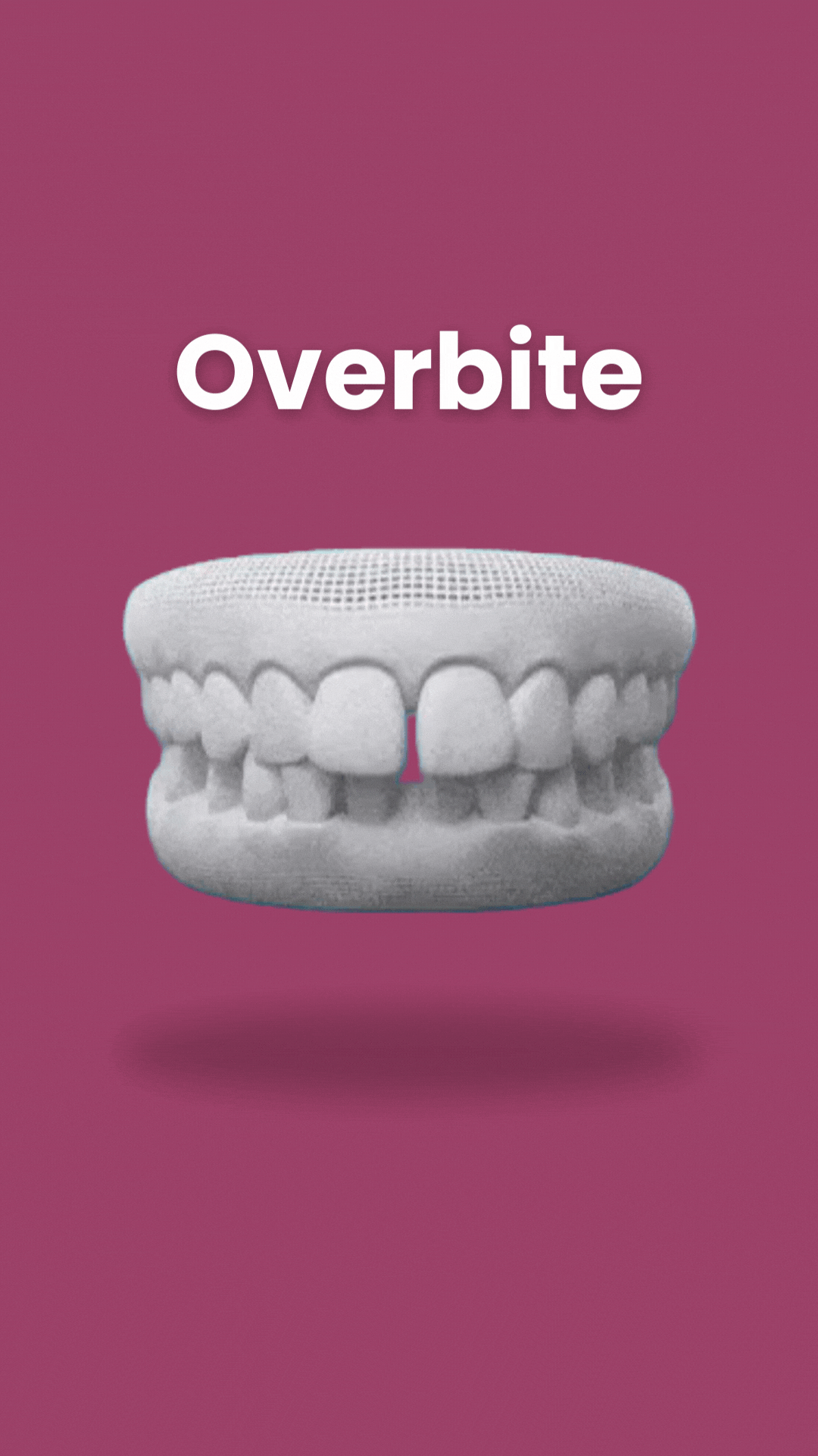 3D dental model showing overbite malocclusion against pink background with "Overbite" text label.