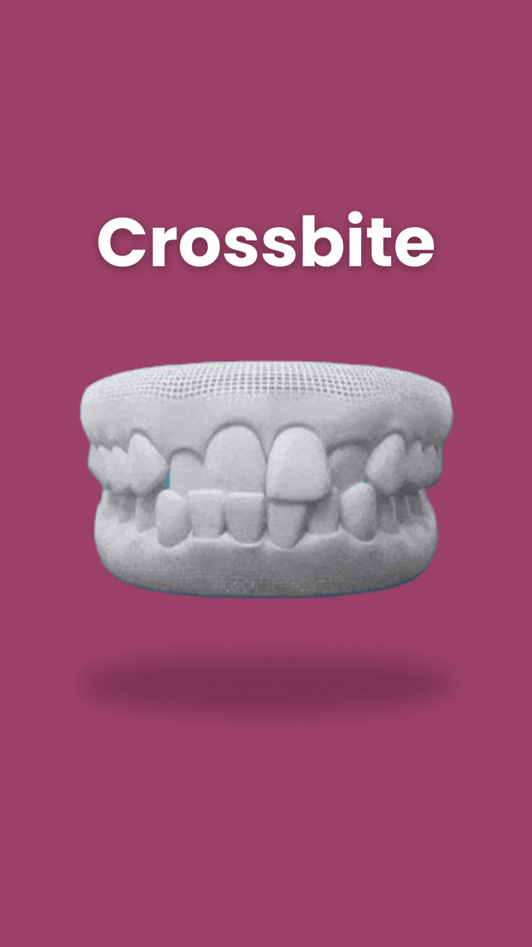 Crossbite dental model showing misaligned teeth on pink background for orthodontics education.