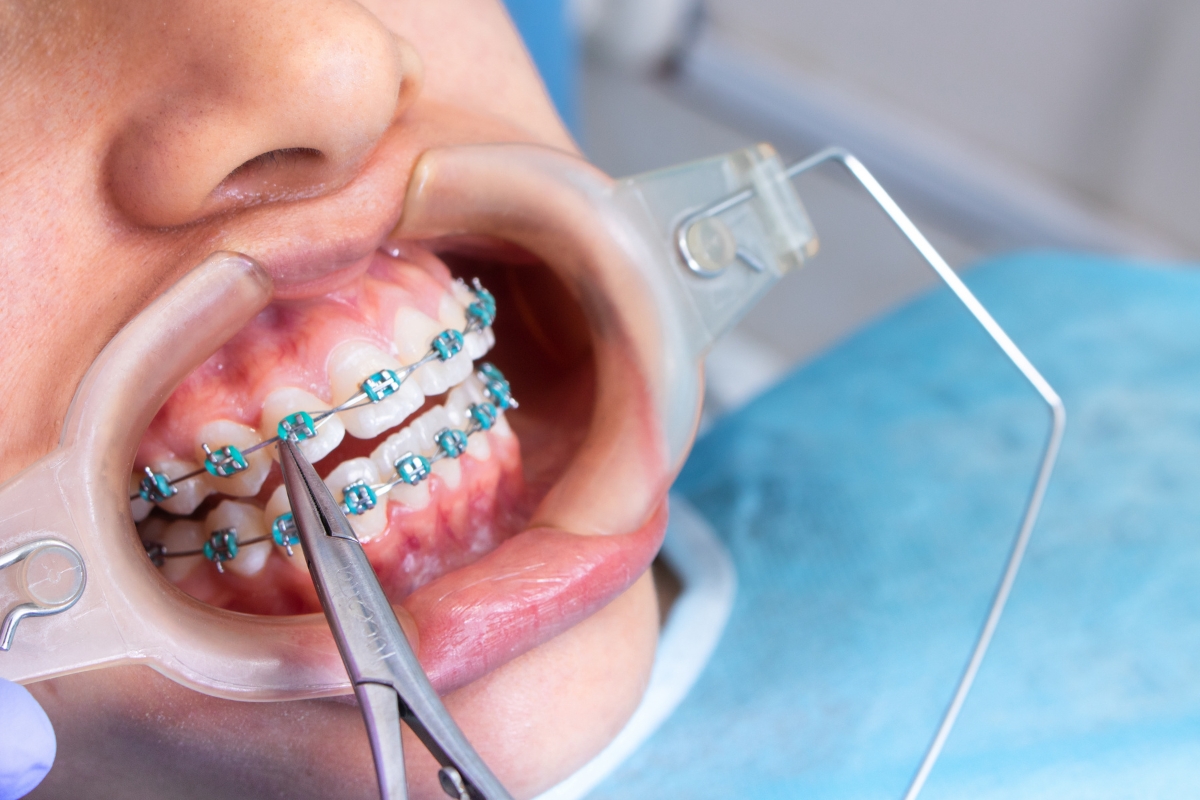 Orthodontist adjusting braces for open bite treatment to improve bite alignment and smile
