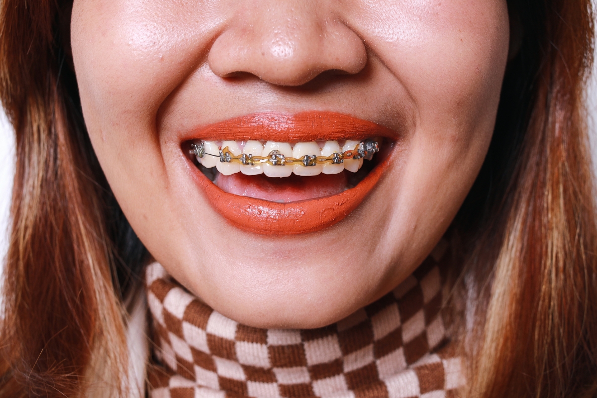 Foods you can eat with braces including soft meals and safe options for orthodontic care