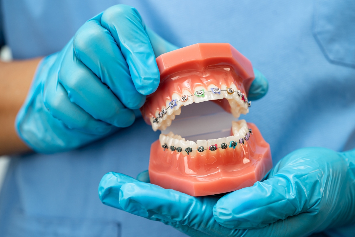 Dental braces model showing treatment for crooked and misaligned teeth
